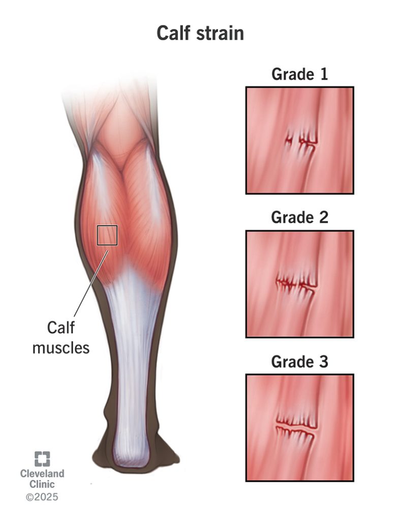 How to Prevent Calf Muscle Injuries
