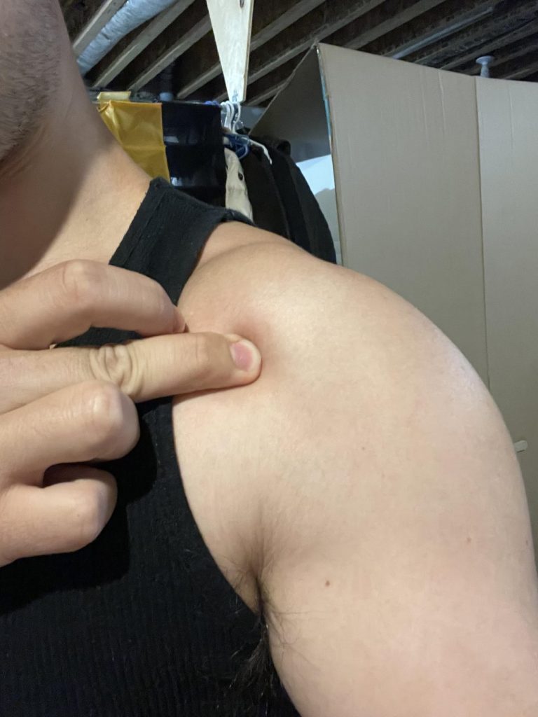 How to Prevent Shoulder Injuries Reddit